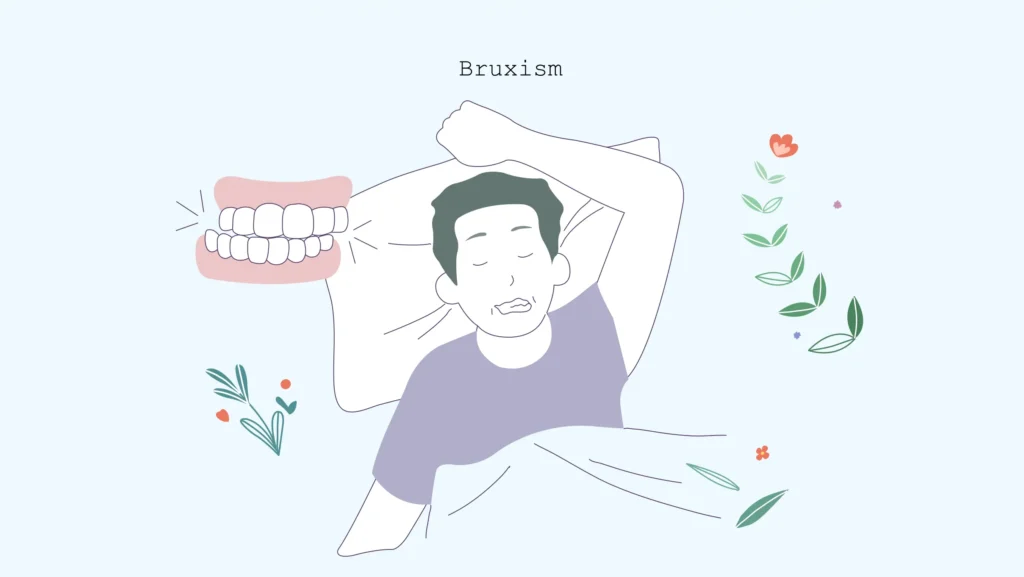 Bruxism: Teeth Grinding